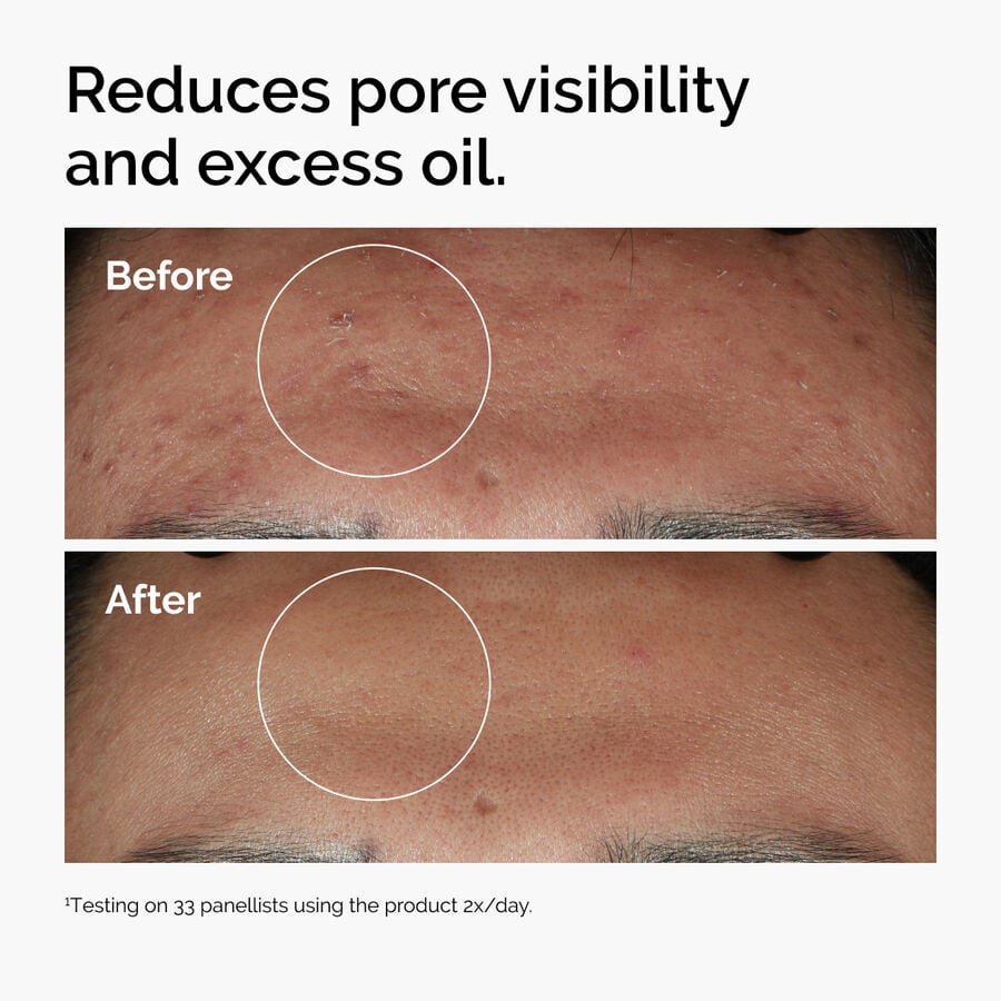 niacinamide-10-zinc-1-a9 ord-niacinamide-zinc-blemish-serum-before-after-pores.jpg